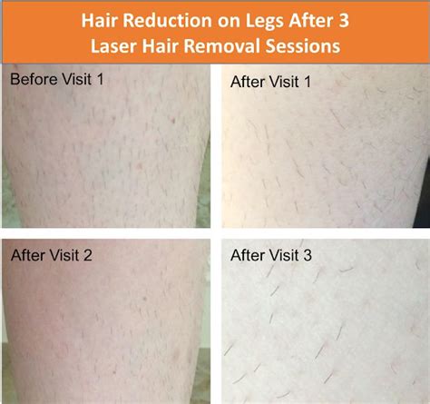 brazilian laser hair removal procedure